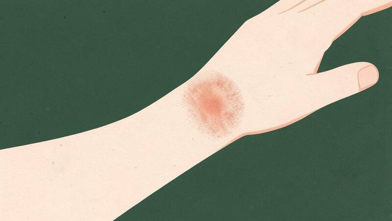 Illustration of a forearm with a patch of dry, irritated skin